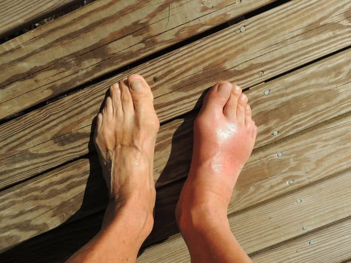 Do You Have Gout? What Is Gout and What Causes It?