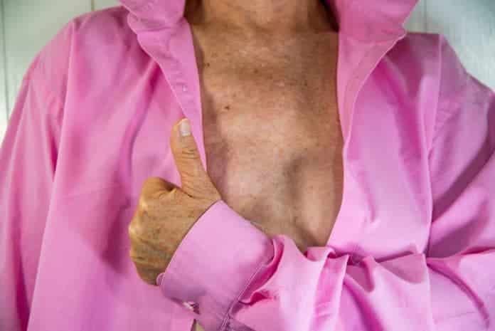 woman with a mastectomy