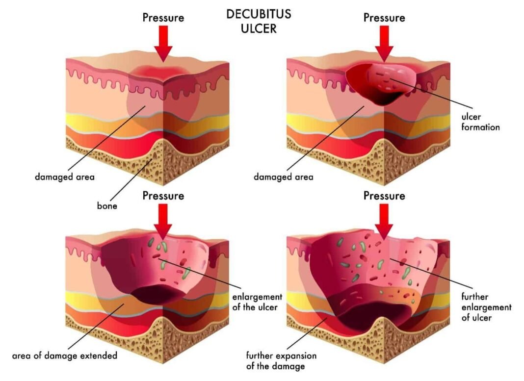 What You Need to Know About 5 Common Types of Wounds in the Elderly