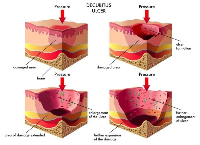 What You Need to Know About 5 Common Types of Wounds in the Elderly