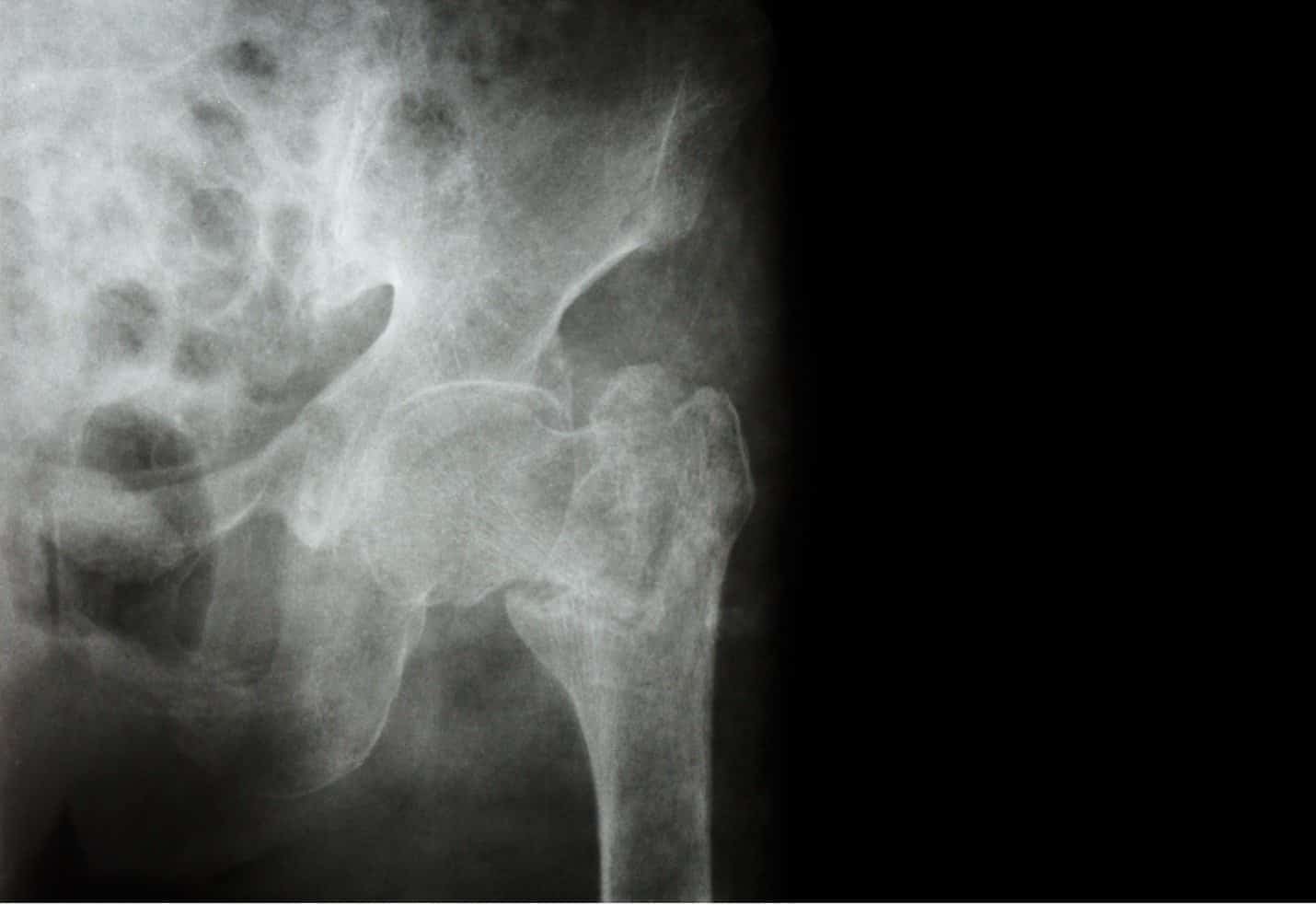 Hip Fractures 1