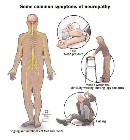 How to Tell if You Have Neuropathy: Early Signs & Next Steps 3 Neuropathy cleveland clinic
