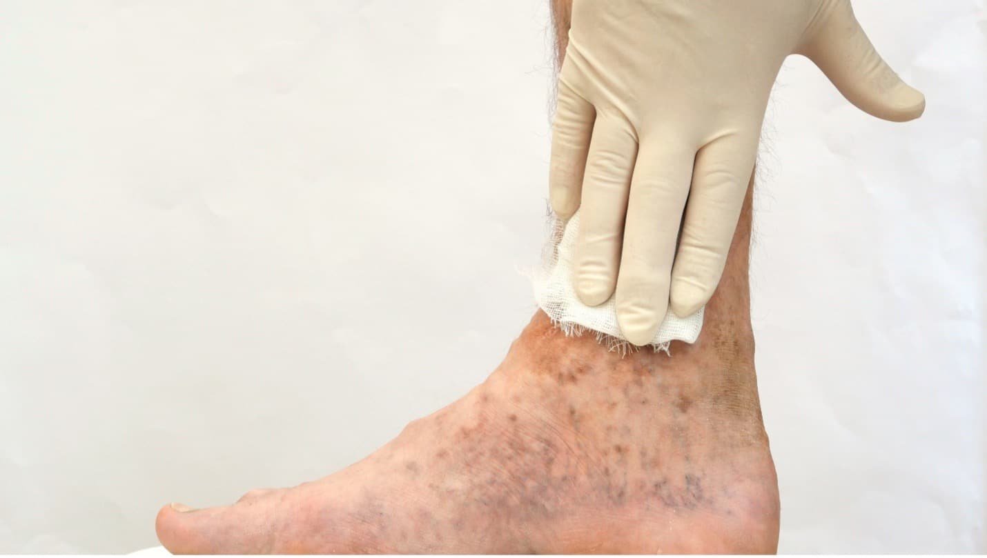 Wound Treatment and Management Protocols in The Elderly 1