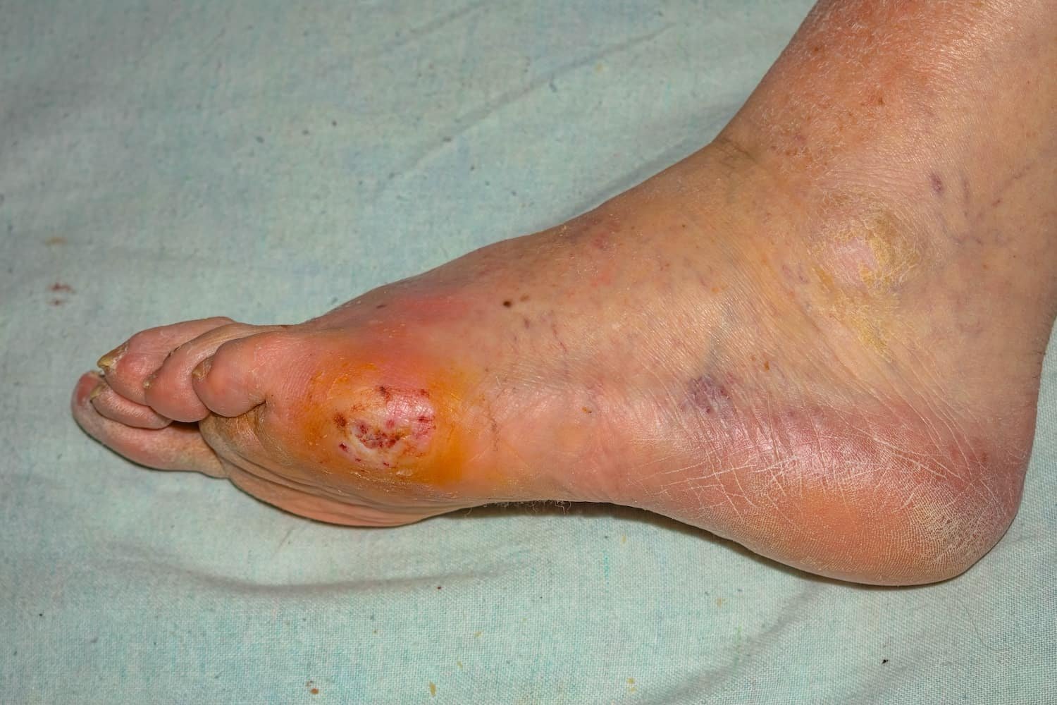 How to Tell if You Have Neuropathy: Early Signs & Next Steps 4 Diabetic Peripheral Neuropathy