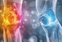 CBD and Gout: What the Research Says CBD and Gout: What the Research Says